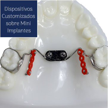 Dispositivos Individualizados Sobre Mini Implantes