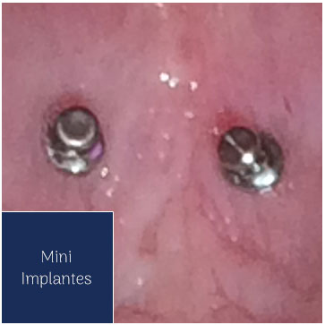 Mini Implantes
