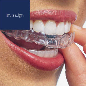 Invisalign