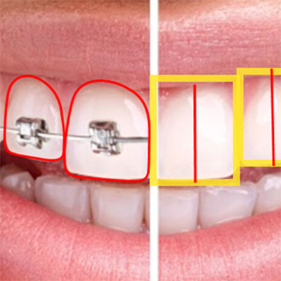ortodontia e seus dispositivos