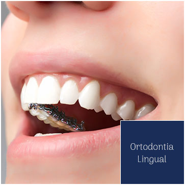 Ortodontia Lingual